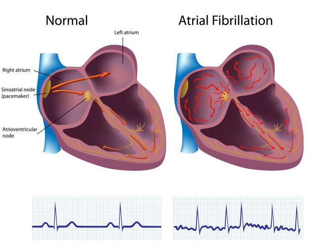 La fibrillation atriale