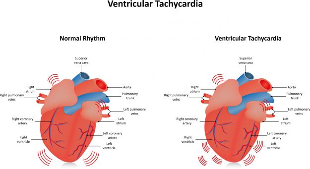 Les tachycardies ventriculaires