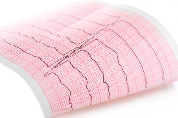 Les troubles du rythme cardiaque