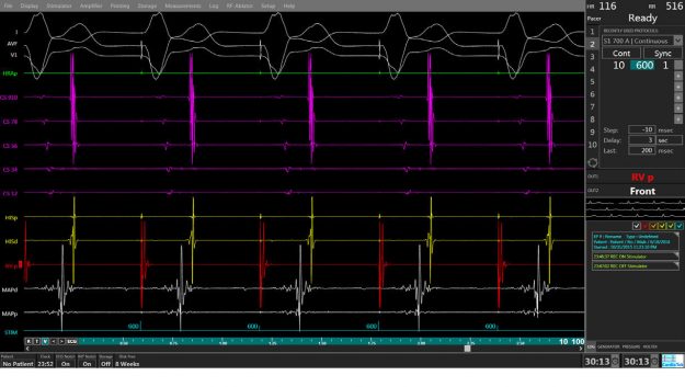 L'exploration électrophysiologique