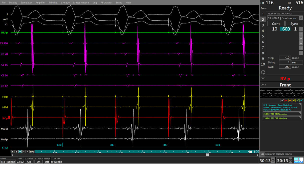 L’exploration électrophysiologique Rythmo