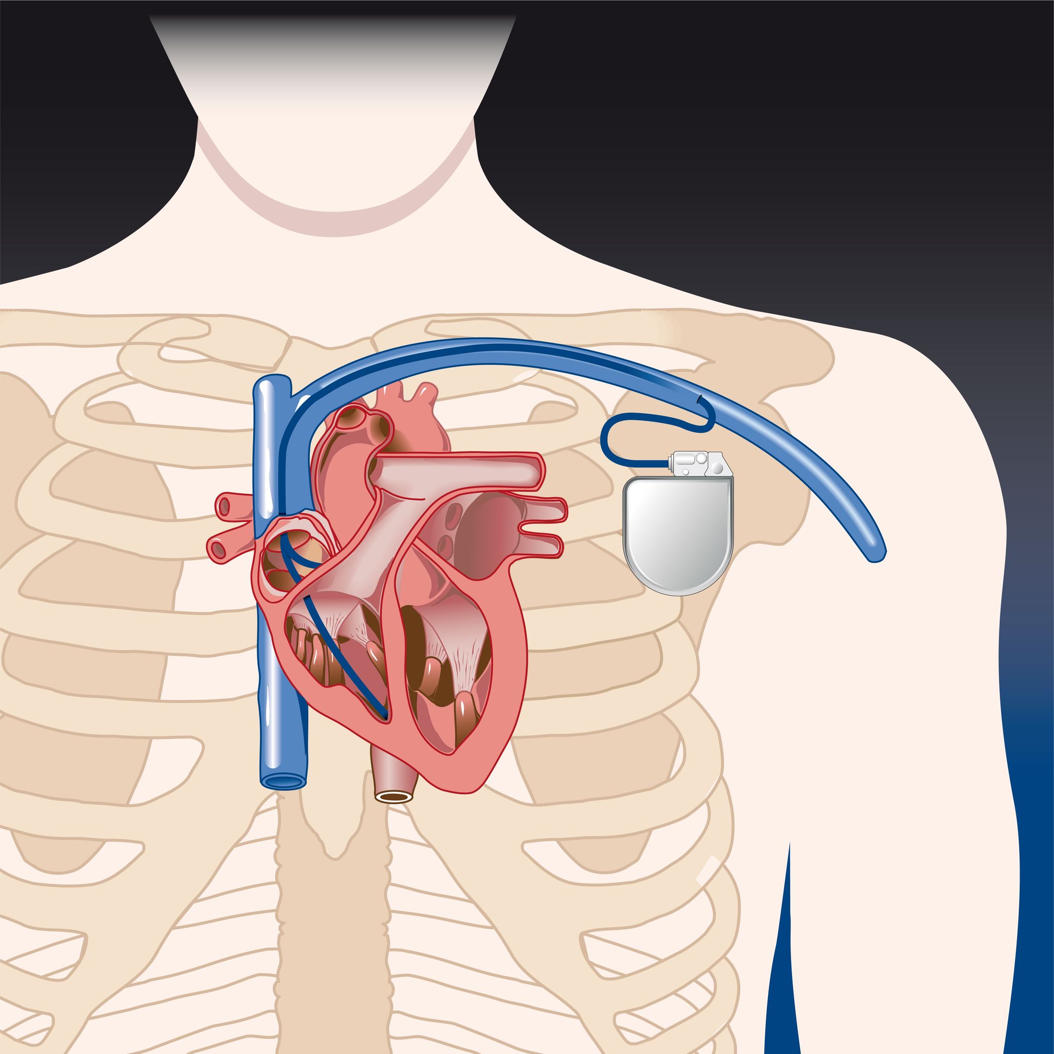 Pacemaker: stimulateur cardiaque