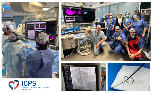 Photos d'une ablation avec le système d'électroporation Medtronic à l'Institut Cardiovasculaire Paris Sud