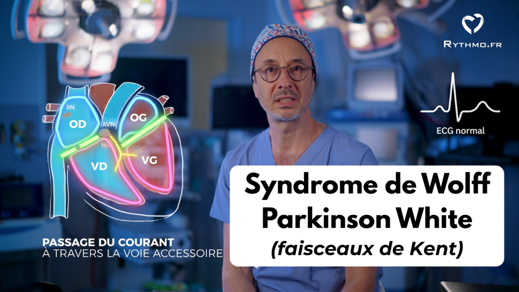 Video Syndrome de Wolff Parkinson White