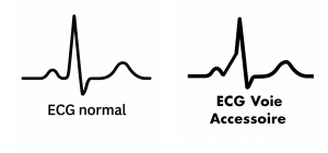 ecg de faisceau de kent